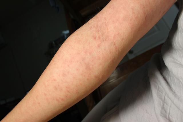 25岁女孩浑身起红疹,医生找不到病因,女孩低头说曾在东莞工作