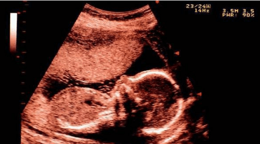 这个方法看胎儿的性别, 测试过的宝妈都说准