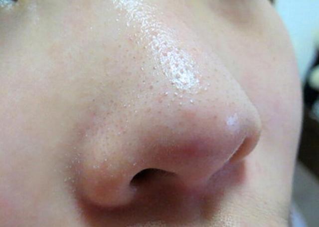 鼻子总是有白色颗粒冒出头?可能是螨虫在作
