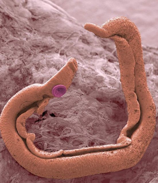 人体中最常见的寄生虫,你体内可能也有