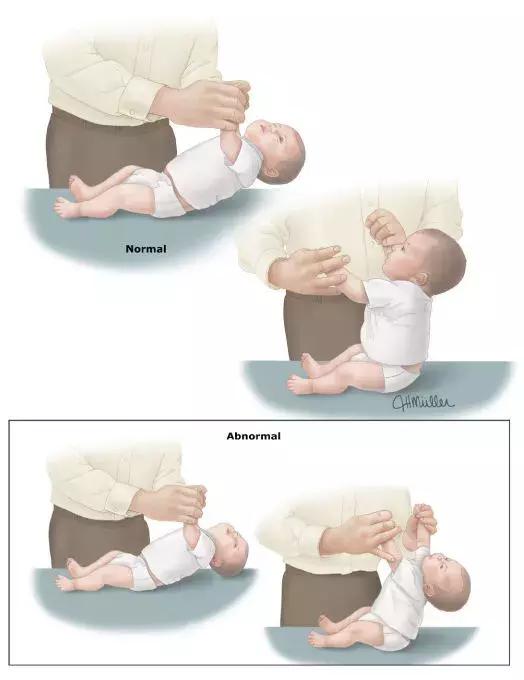 讲讲婴儿肌张力异常的这件小事儿!