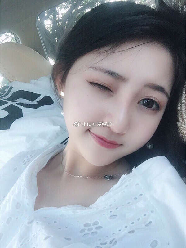 广州鼻综合手术恢复日记:终于不用被他笑猪鼻