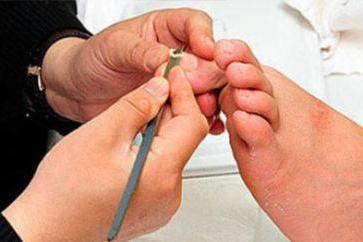 为什么很多人的脚指甲,都会长到肉里面?