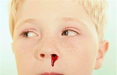 儿子的鼻子一碰就流血, 听了老医生的法子一下就止住了!