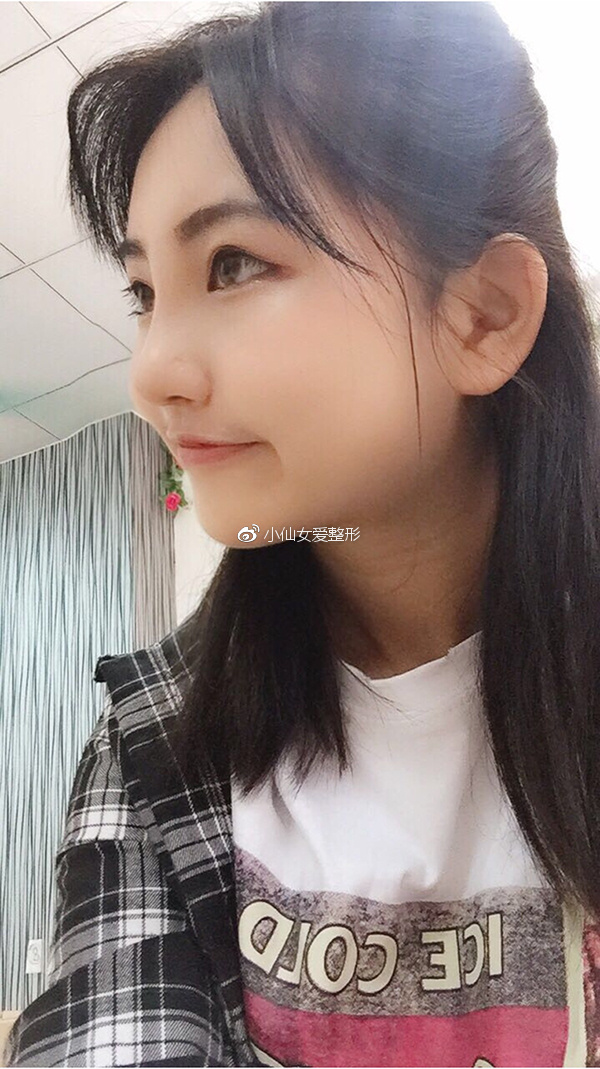 广州鼻综合手术恢复日记:终于不用被他笑猪鼻