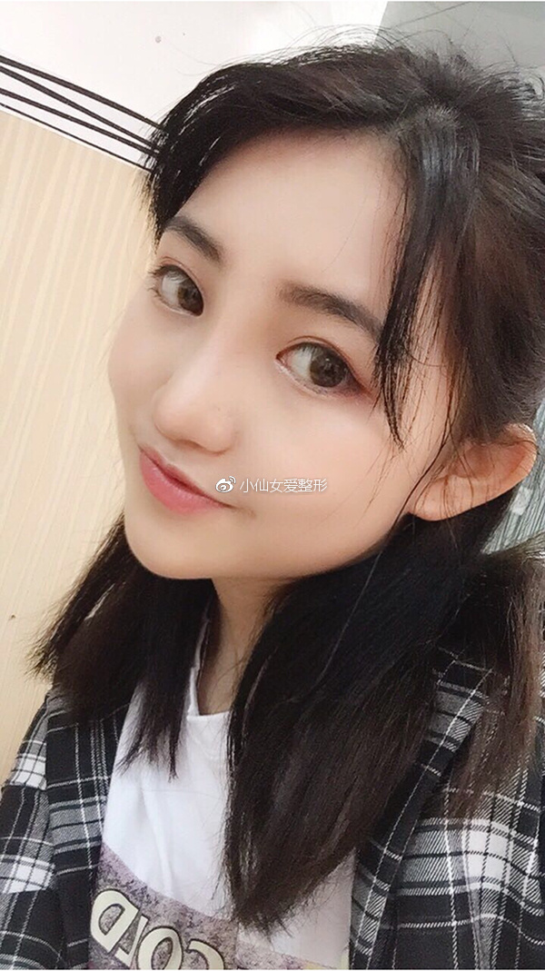 广州鼻综合手术恢复日记:终于不用被他笑猪鼻