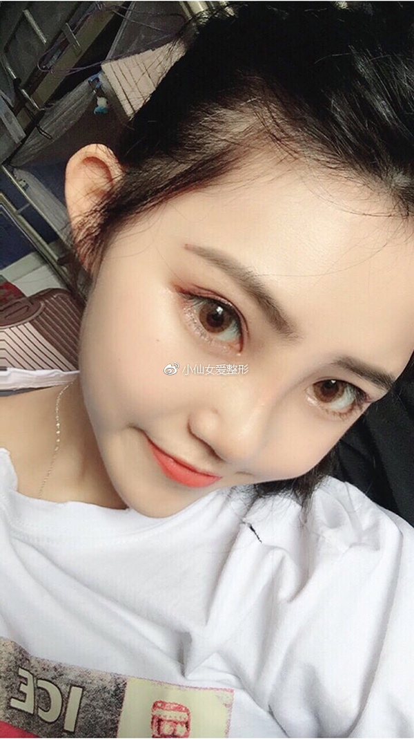 广州鼻综合手术恢复日记:终于不用被他笑猪鼻