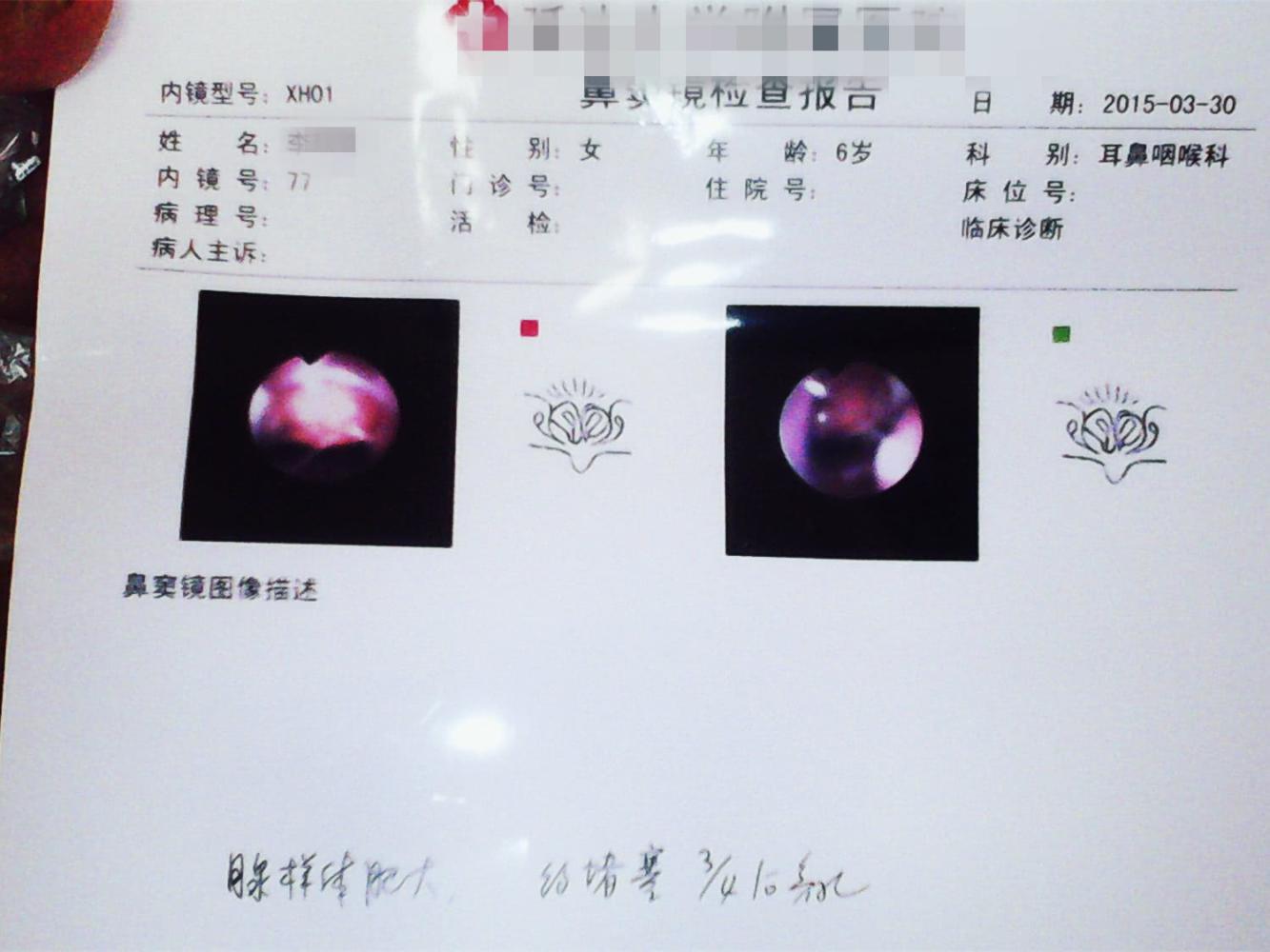 别让腺样体面容毁了孩子的颜值