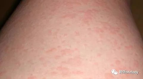 真相惊人!艾灸后皮肤瘙痒,竟然是一件好事!