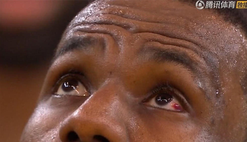 眼睛被戳伤的詹姆斯面临巨大风险 再遭撞击或