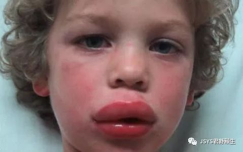 遇阴天、雨天就皮肤过敏,瘙痒、起疹…,比天气