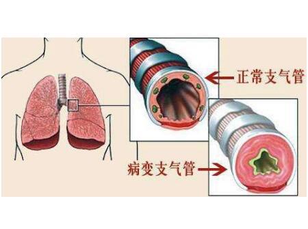 小儿毛细的支气管炎原因!