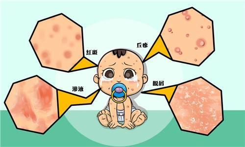 3个月宝宝奶癣总反复,妈妈护理这样做 宝宝更健康