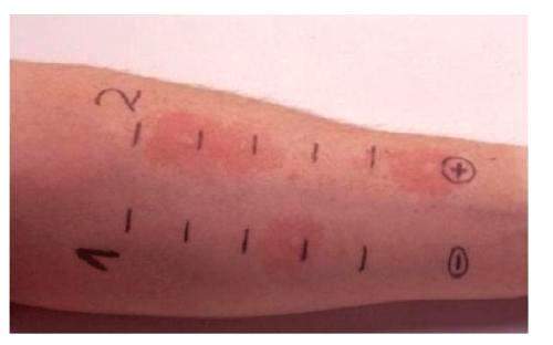 小儿荨麻疹的头号天敌,坚持一个月,3年小儿荨麻疹彻底不见!