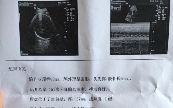 B超单上这2项数据可能隐藏了胎宝性别小秘密