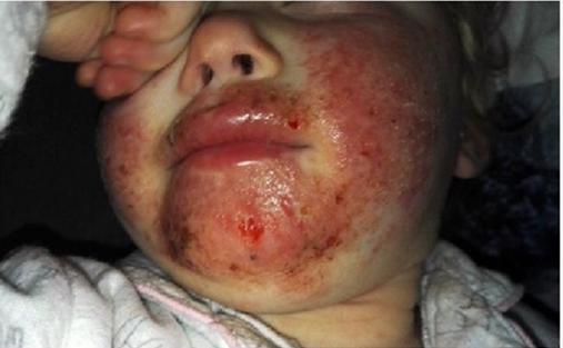 疱疹用什么软膏 5d1f-hkrzvkw3715389.jpg