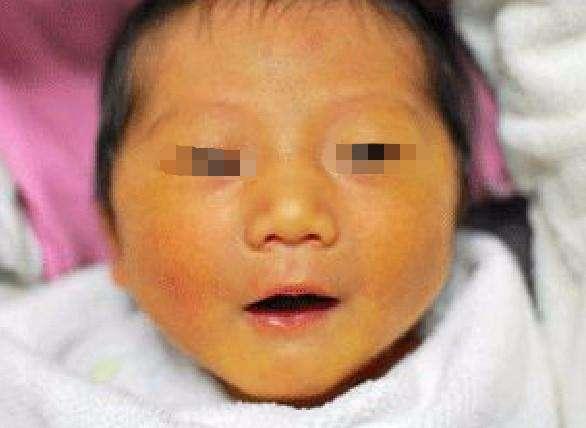 两个月宝宝因黄疸不消被医生告知是脑瘫,有这