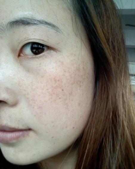 祛斑巧点子,只需维E加一粒,涂脸一周色素斑点