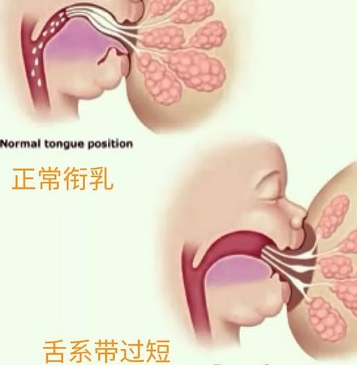 本来新生儿吃奶是用舌头垫在下面的,如果舌系带过短,舌头无法裹住奶头