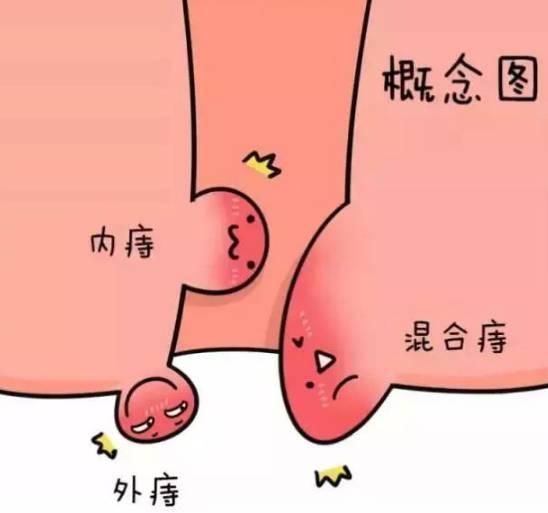 这几个小常识, 让你有用的防治痔疮!