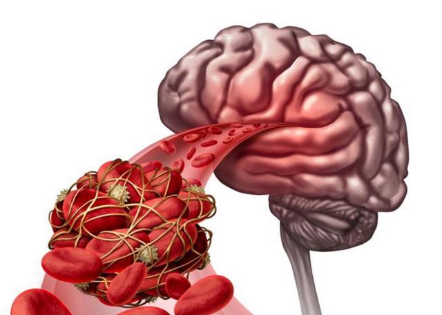发现自己脑血管堵塞怎么办?做到3个一,脑中