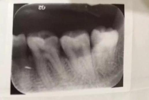 补牙、拔智齿、根管治疗、戴牙冠来个遍!牙不