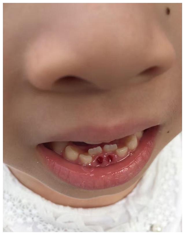 儿童的乳牙还没有恢复,新的牙齿将会长出.我该怎样办?