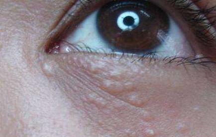 眼部周围的"小疙瘩"是什么? 怎样才能将它们清理干净