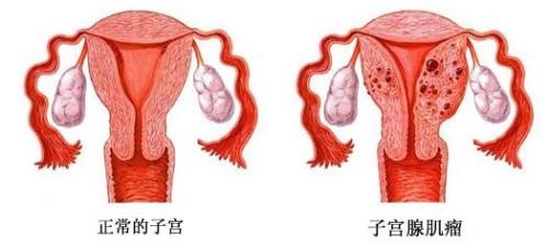 深夜产房:孕妇带瘤怀孕,比胎儿还重,三分之二营