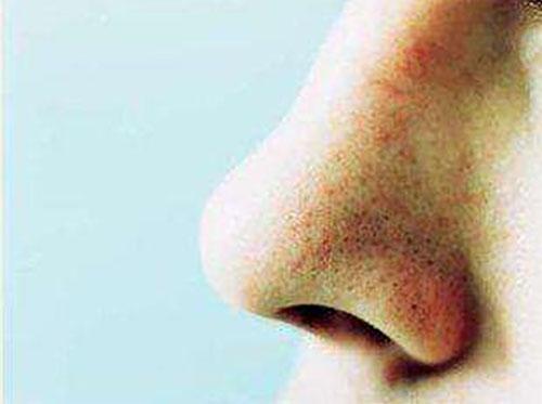 脸上挤出白色分泌物,网友表示:里面都是螨虫,2