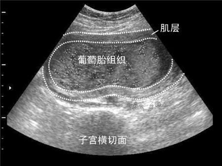 年轻女孩腹部隆起，如同怀孕7个月孕妇，检查之后医生傻眼了！
