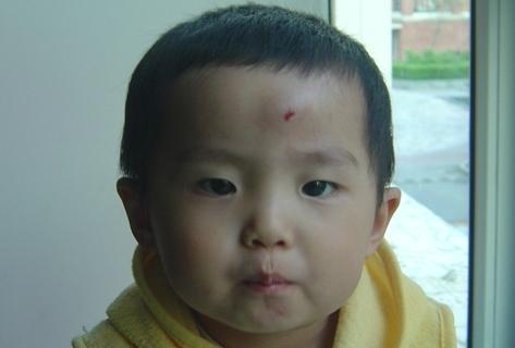 两岁宝宝玩耍摔倒后额头摔个大包,奶奶这样处