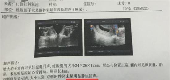 怀孕两次都两个月胎停, 一直找不到原因, 原来不