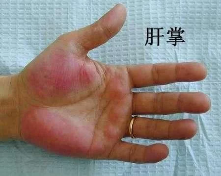 这是肝脏功能异常特有的一种体征,如果病情比较严重,在手掌还可能会