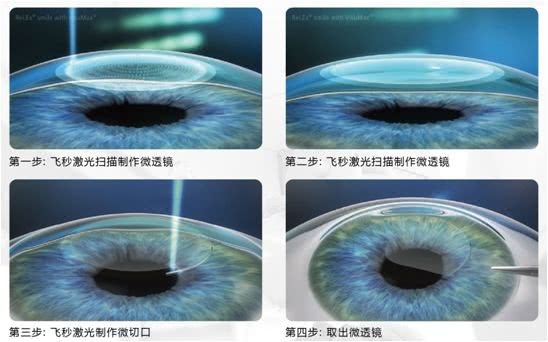 眼睛激光原理是什么_激光是什么样子图片(2)