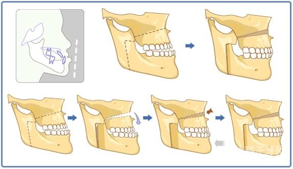 地包天如何治疗