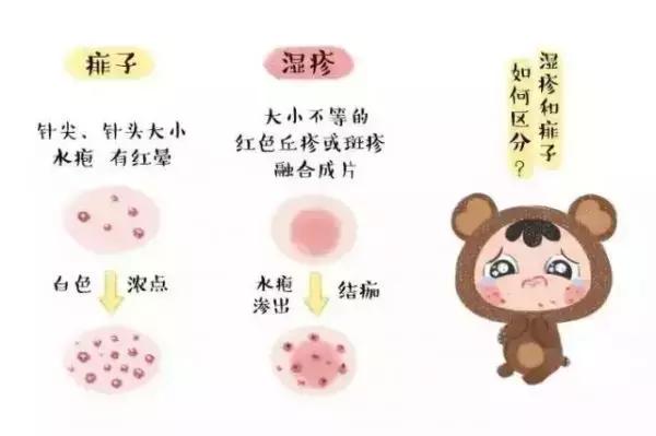 湿疹有几种类型和图片
