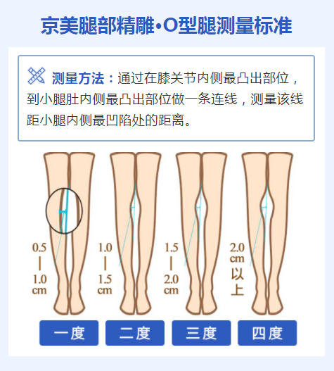 O型腿的判断标准