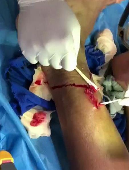 "今晚对阵河南建业的比赛中,特谢拉被对方门将鞋钉踢破腿部,现场包扎
