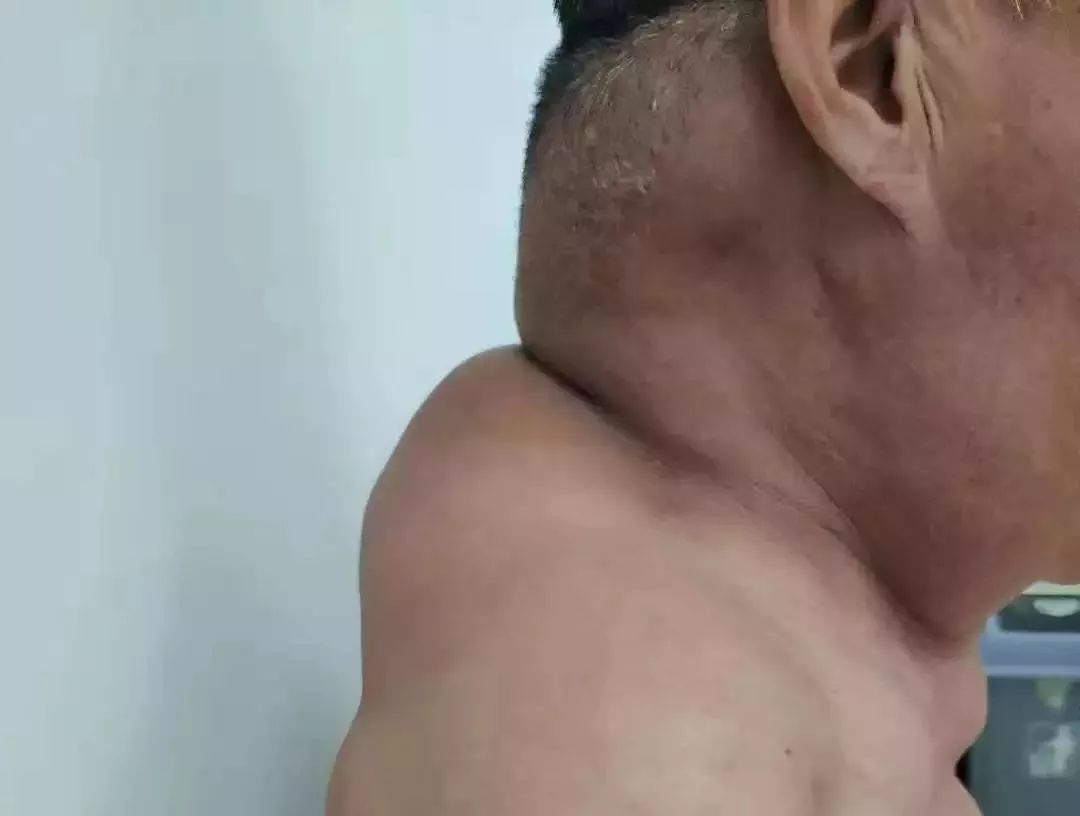 过详细检查,宋先生被确诊患上了马德龙病,一种良性对称性脂肪瘤病