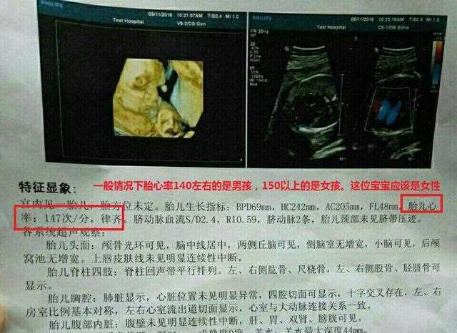 准确率90%!看B超识别胎儿性别,几个小办法教