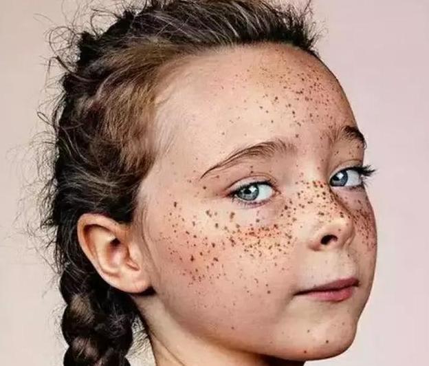 原来让外国女孩长雀斑, 中国女孩长痘的原因是