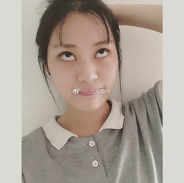 双眼皮术后为什么要多翻白眼?