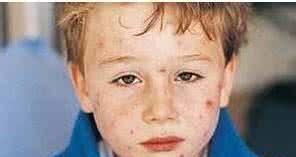 幼儿水痘止痒和治疗的方法 很有用