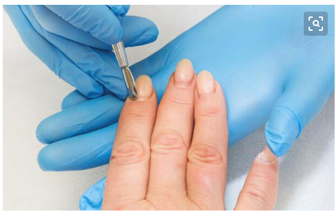 不用去医院就能治好灰指甲,民间偏方,很多人都