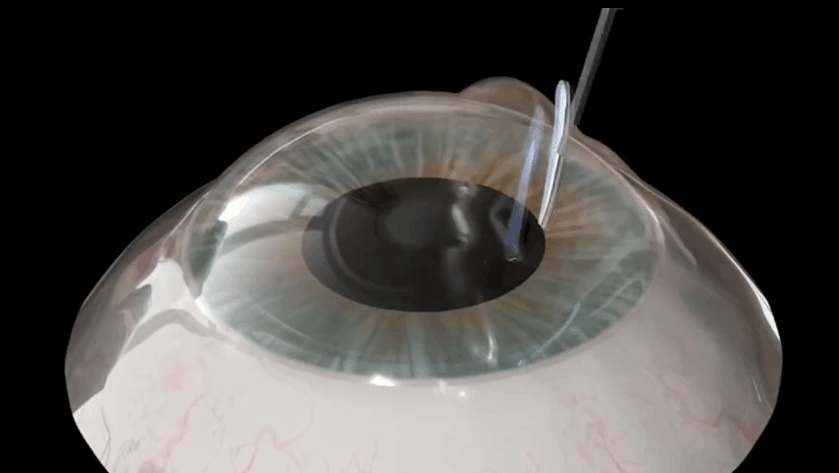 不可思议!人类发明出3D打印人工眼角膜,6分钟