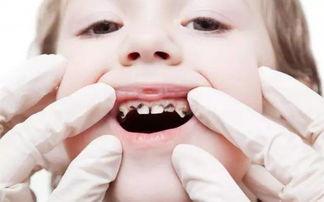 七岁的孩子换牙,父母注意好这几点,孩子牙齿不