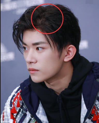 易烊千玺剃头后出现了后遗症,头发稀疏,头顶都不长头发了