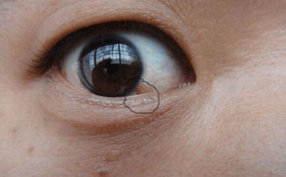 医生告诫:肝癌一发现就晚期,4个标准看看你的肝干净吗