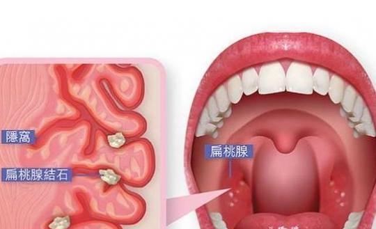 早上起来喉咙老有异物, 一直咳不出来, 用手抠抠